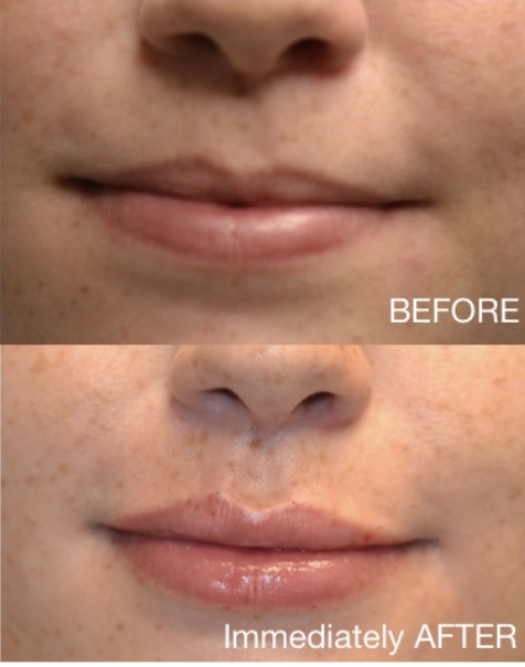 Lip lift before and after.
