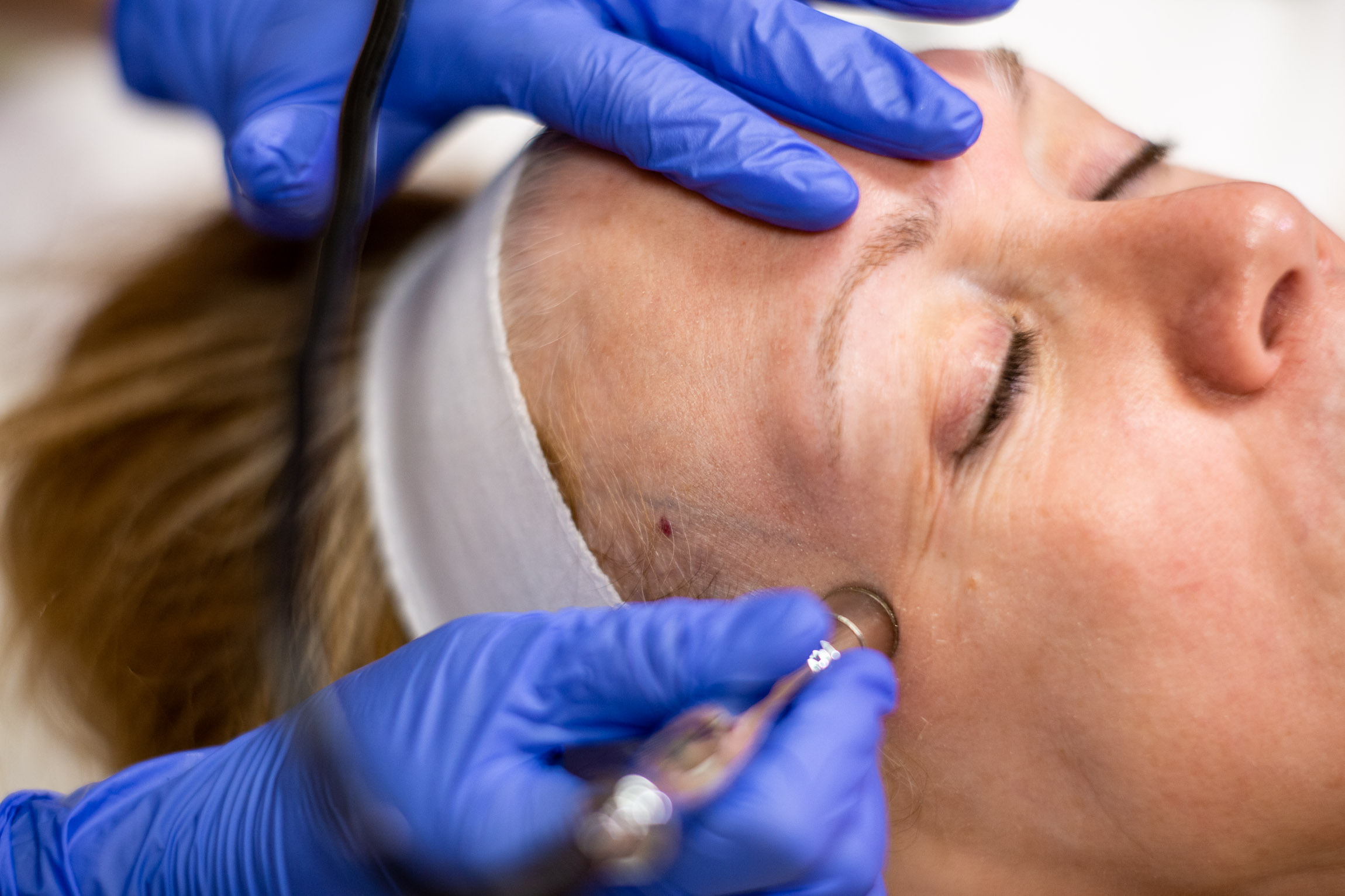 female patient receiving treatment for microdermabrasion in Rochester, NY