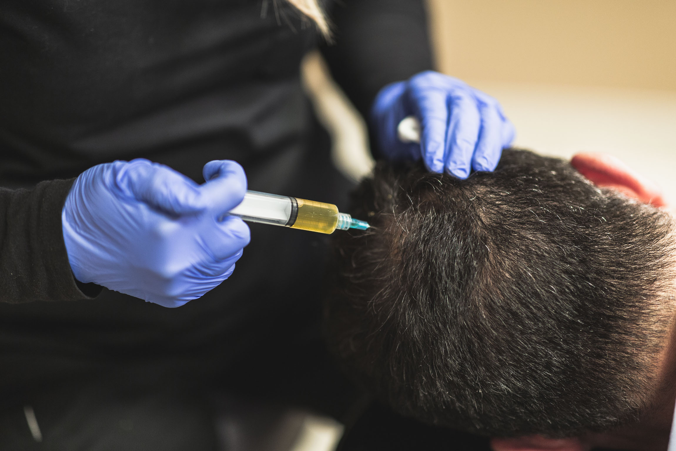 PRP injection for hair loss as an alternative to hair transplant surgery in Rochester