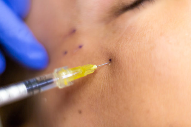 rochester botox and fillers