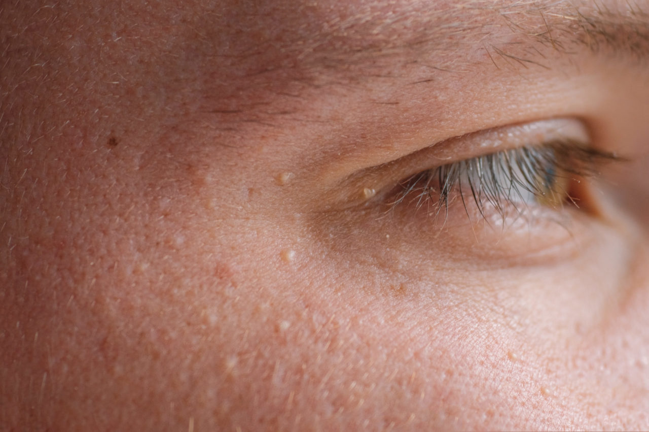 Milia (Milium) - pimples around eye on skin. Eyes of young man with small papillomas on eyelids or growths on skin