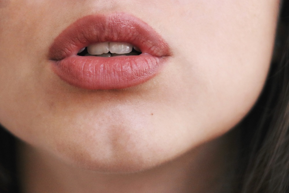 woman's lip with Kysse lip filler